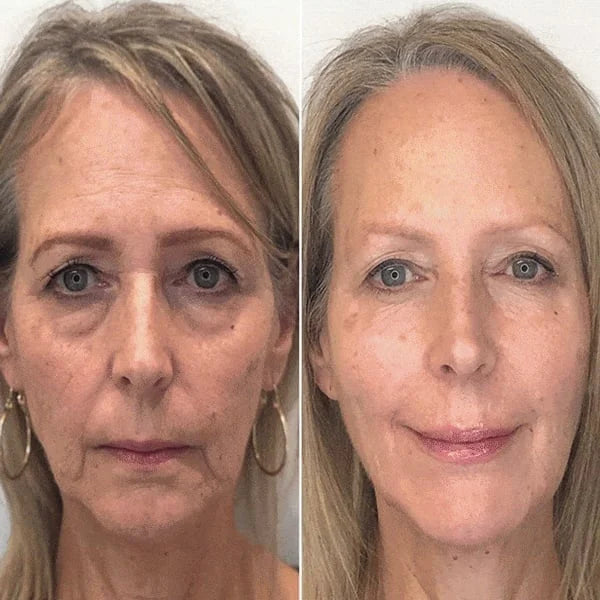 🎉Buy 1 Get 1 Free🎁 - Botox Face Serum