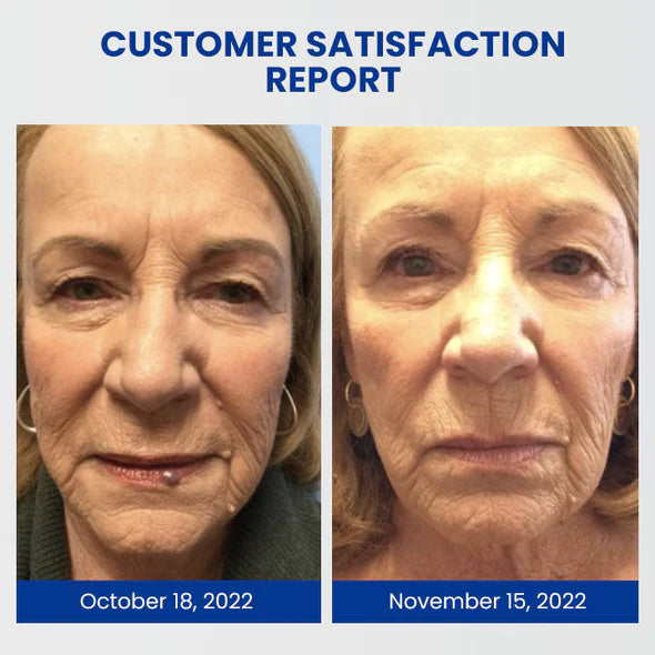 Kasperfect TM WartsOff Instant Blemish Removal Cream